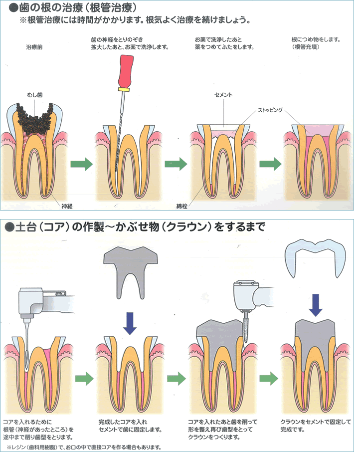 根管治療ってなんだろう の巻 糟屋郡須恵町 公式 つつみ歯科医院 糟屋郡須恵町のつつみ歯科医院