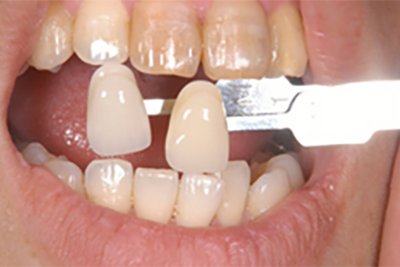 ジルコニアの写真｜つつみ歯科医院