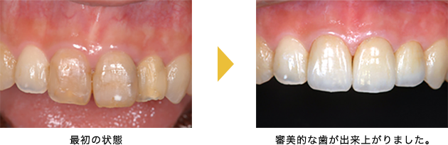 審美的な歯が出来上がりました