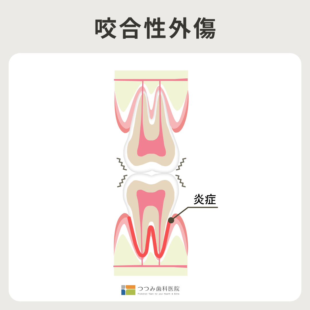 つつみ歯科医院 咬合性外傷