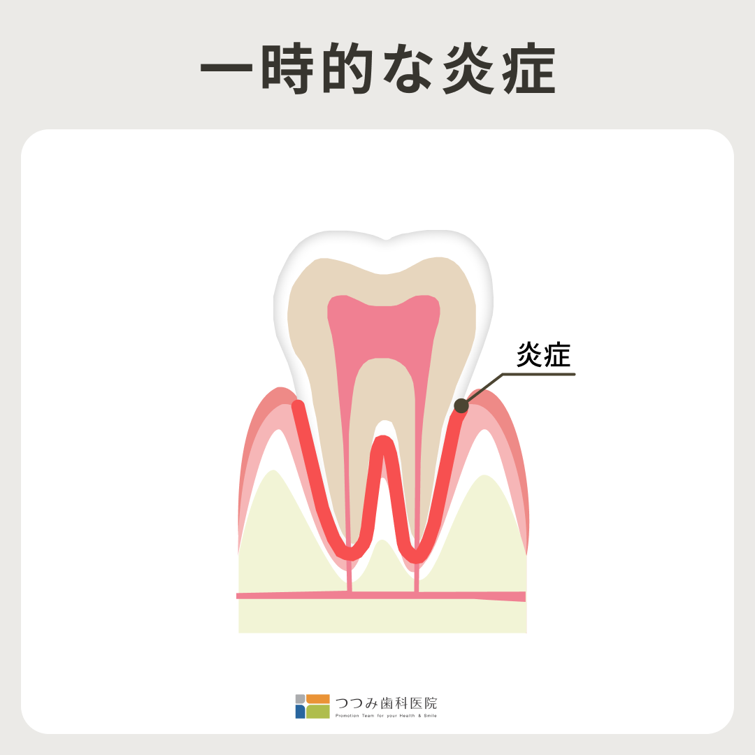 神経を抜いたのになぜ歯が痛くなる？
つつみ歯科医院｜糟屋郡須恵町の歯科医院