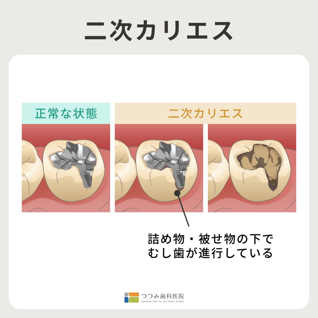 なぜ？むし歯治療したのにまた痛い…。「二次カリエス」のサインと見つけ方｜ #1　つつみ歯科医院
