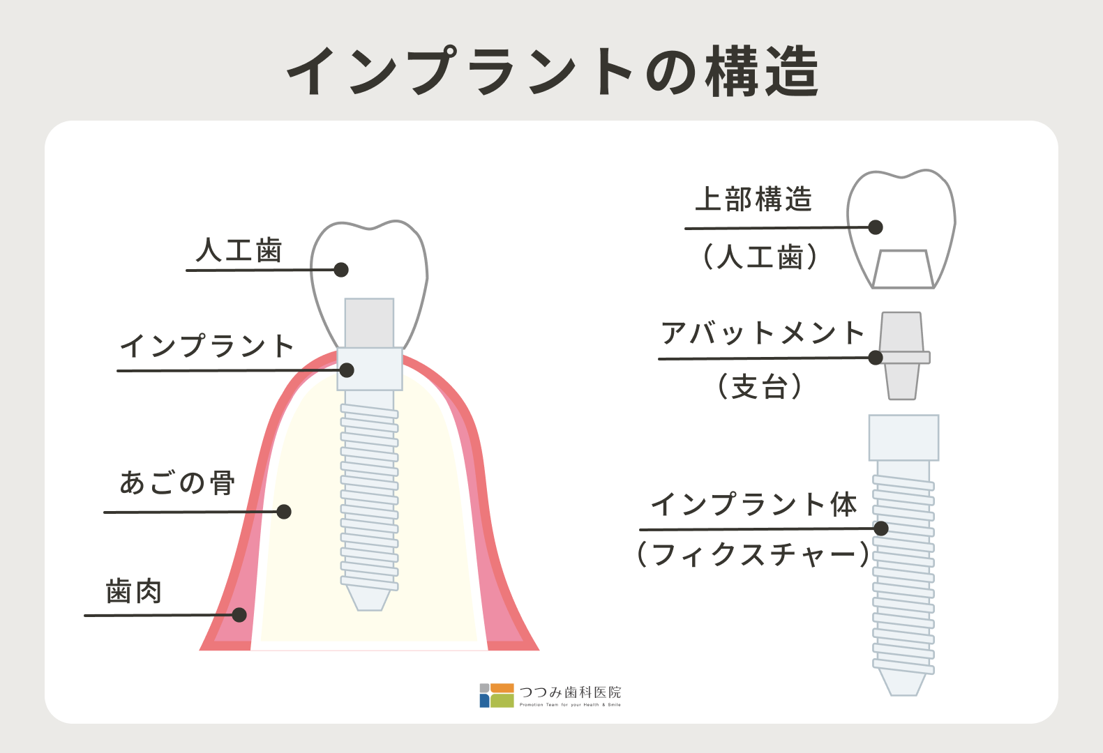 インプラントの構造｜｜つつみ歯科医院