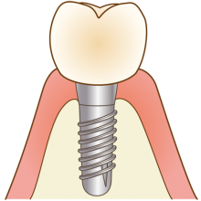 インプラント
