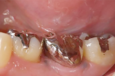 歯の移植について